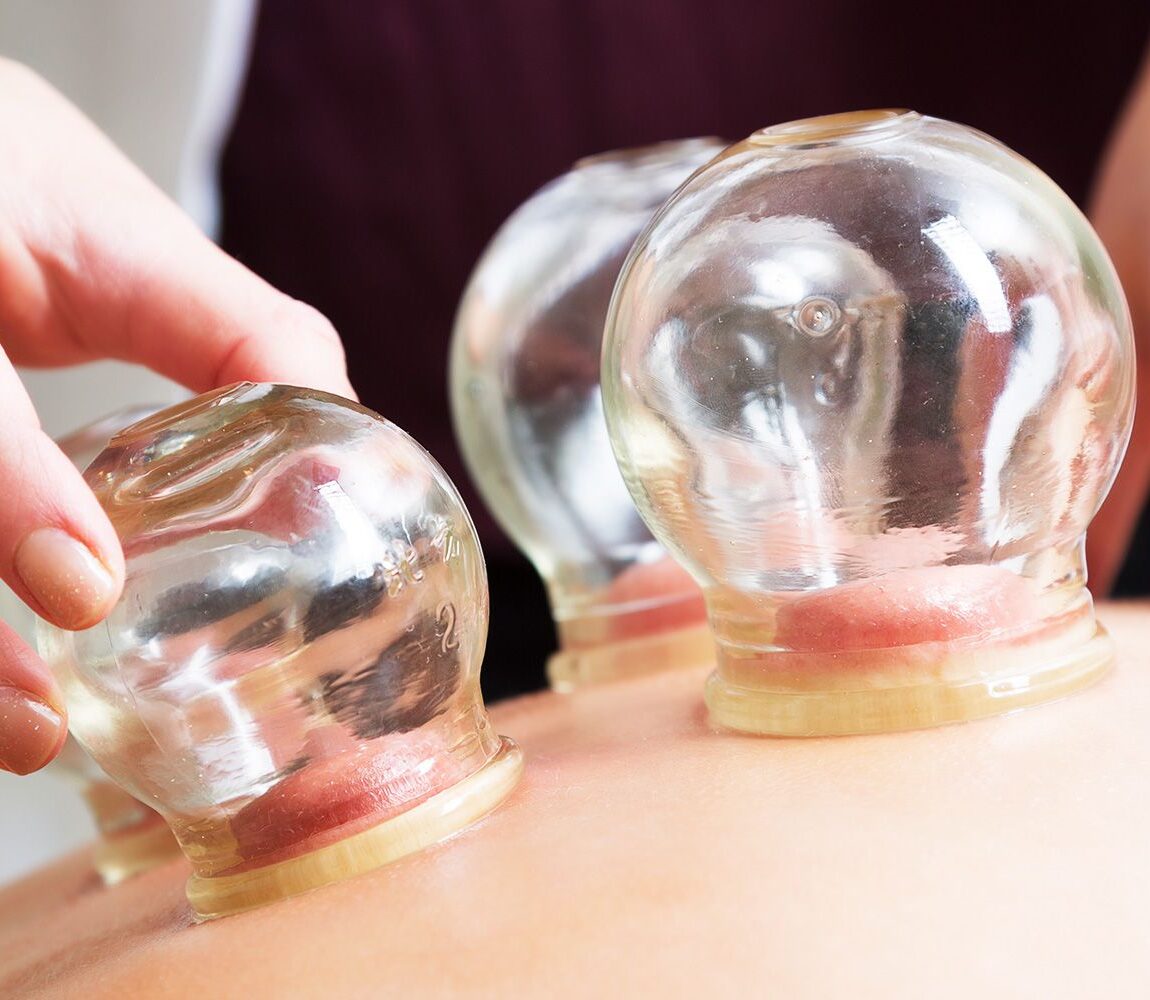 cupping