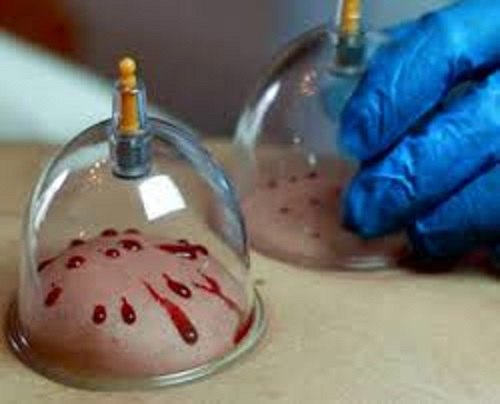 hijama